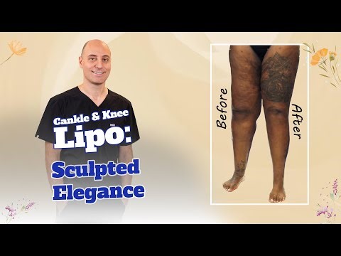 Unbelievable 360 Leg Liposuction in Tampa by Dr. Kardashian: Awake Cankle and Knee Transformation! 🤯