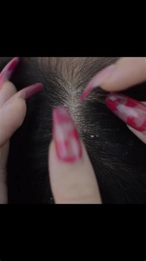 Asmr Nitpicking, Scalp Picking #asmr #nitpicking #scalpcheck | asmr
