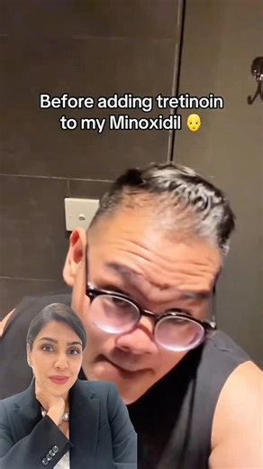 Amanjot Arora Khokhar on Instagram: "How to Use Tretinoin + Minoxidil Together for MAX Hair Growth (Dermatologist-Approved) 💆‍♀️✨ Struggling with slow results from minoxidil alone? Here’s how dermatologists combine tretinoin + minoxidil to boost absorption and stimulate real regrowth 👇 ✔️ Start with a COMPLETELY dry scalp Any moisture increases irritation and reduces tolerance. ✔️ When using tretinoin cream separately, use a TINY amount of tretinoin A pea-sized amount only on thinning areas - 