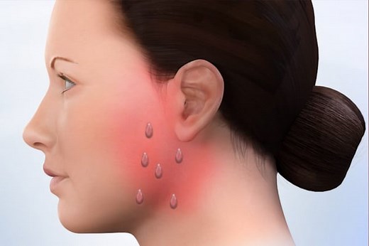 Frey’s Syndrome Treatment - Parotid Tumor Surgery | Salivary Gland Surgery Los Angeles CA