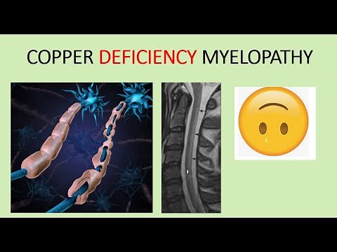 Copper deficiency Myelopathy