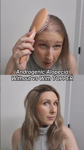 Androgenic Alopecia: Before & After with a Hair Topper! | UniWigs Upgrade Courtney