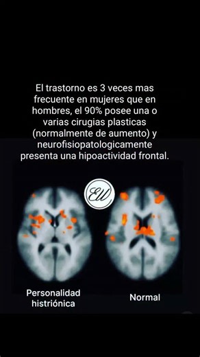 Ezequiel Fernando Uribe Nobrega on Instagram: "Torrico TJ, French JH, Aslam SP, et al. Histrionic Personality Disorder. [Updated 2024 Jun 20]. In: StatPearls [Internet]. Treasure Island (FL): StatPearls Publishing; 2025 Jan-. Available from: https://www.ncbi.nlm.nih.gov/books/NBK542325/ #neuropsychiatry_"