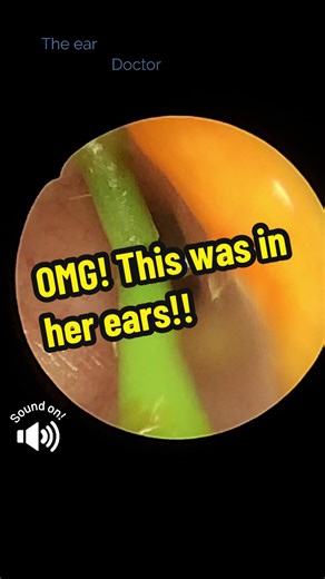 This patient had a T tube stuck in her ears for 3 years. Her symptoms? Blocked feeling, itchy ears, reduced hearing. She went to her GP and they said it was all fine!! Good thing she booked with us at The Ear Doctor clinic. We cleared her ears, examined her properly and sent her for a hearing test. If you need your ears checked and reassurance, book now, links in bio #creatorsearchinsights #earwaxcleaning #london #hearing #fyp