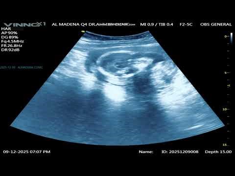 OBST 5 : 17W5D SVF 2025 12 09 19 01