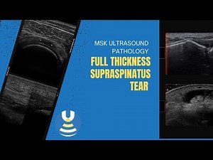 Full thickness Supraspinatus tear on ultrasound
