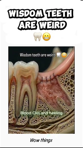 Wisdom teeth are weird. See how to remove them