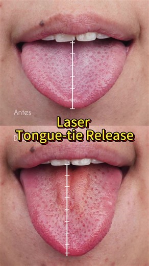 See how good is the dental diode laser in tongue-tie release! It makes ultra-precise incisions while sealing tissues, reducing bleeding and discomfort. Compared to traditional frenectomy, this method requires no suturing and enables rapid wound healing. Postoperatively, laser biostimulation could be applied to further enhance recovery and reduce pain. #dentallaser #laserdentistry #teethwhitening #bluelaser #oralsurgery #lasersurgery #orallasertherapy #laserodontologico #980nm #635nm #450nm #Bios