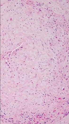 Giant cell (temporal) arteritis- Pathology #shorts