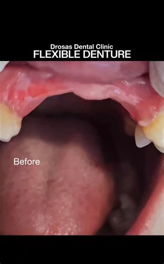 𝐄𝐱𝐩𝐞𝐫𝐢𝐞𝐧𝐜𝐞 𝐂𝐨𝐦𝐟𝐨𝐫𝐭 𝐚𝐧𝐝 𝐒𝐭𝐲𝐥𝐞 𝐰𝐢𝐭𝐡 𝐕𝐚𝐥𝐩𝐥𝐚𝐬𝐭 𝐅𝐥𝐞𝐱𝐢𝐛𝐥𝐞 𝐃𝐞𝐧𝐭𝐮𝐫𝐞𝐬! Say hello to a beautiful, natural-looking smile — without metal clasps! Valplast dentures are made from strong, biocompatible nylon thermoplastic that’s flexible, comfortable, and durable — the perfect blend of function and aesthetics! 🌸 𝐇𝐨𝐰 𝐈𝐭 𝐖𝐨𝐫𝐤𝐬: Instead of metal clasps, Valplast uses flexible nylon extensions that gently grip the natural ridges and undercuts of your