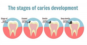 What are Cavities? | Mi DENTAL