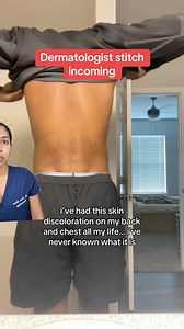 6.7M views · 9.4K reactions | How to treat tinea versicolor like a...