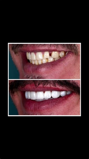 These are zirconia veneers. In order to fix his gap we did 20, 10 on top 10 on bottom