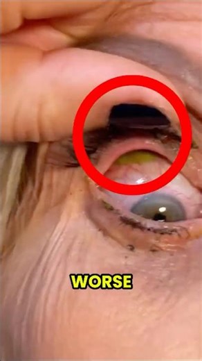 Can You Really Forget 23 Contact Lenses in Your Eye? 🤯👀