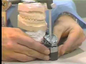 Customized Incisal Guide