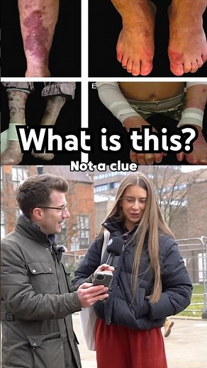 Doctor explains Epidermolysis Bullosa #shorts