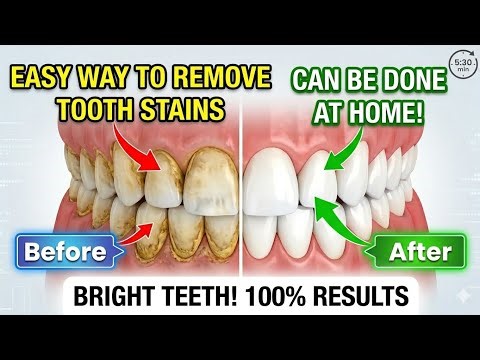 How to Remove Deep Tooth Stains at Home! (Easy DIY Teeth Whitening)