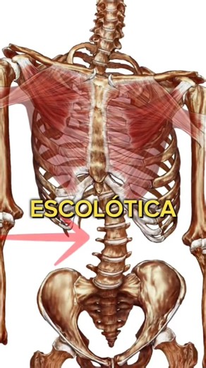 Scoliosis #physicaltherapy #health #yoga