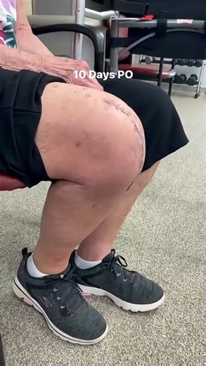 10-days post op. AMAZING range of motion. These are not normal results!!! . #kneepain #totalkneereplacement #physicaltherapy | Total Therapy Solutions: Physical Therapy