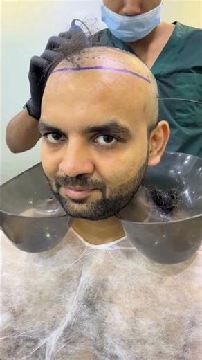 Trimming Before Hair Transplant | Why It’s Important Before Surgery