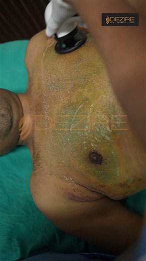 Gynecomastia Dressing and RF Session