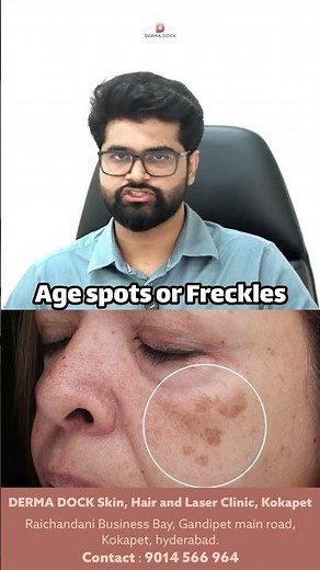 What Is Age Spots and freckles? | How To Remove Age Spots and Freckles| Causes & Treatment#dermadock