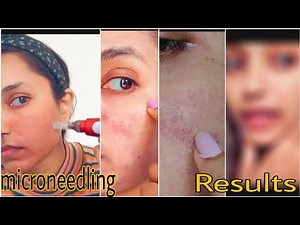 MICRONEEDLING AT HOME Derma Pen Session 2 | Before & After result.