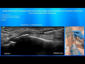 Ultrasound Guided Injection for De Quervain's Tenosynovitis