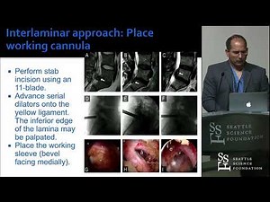 Endoscopic Lumbar Spine Surgery - Christoph P. Hofstetter, MD, PhD