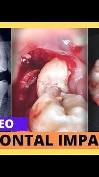 Wisdom Teeth Removal | Impacted tooth extraction | Lower Molar | Your Dentist | #wisdoomteeth