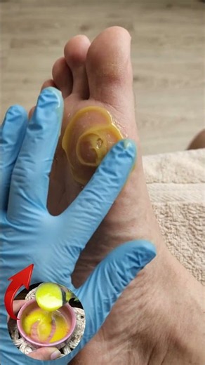 Foot Corn Making Every Step Uncomfortable! Give Your Feet Some Extra Care! 🦶✨
