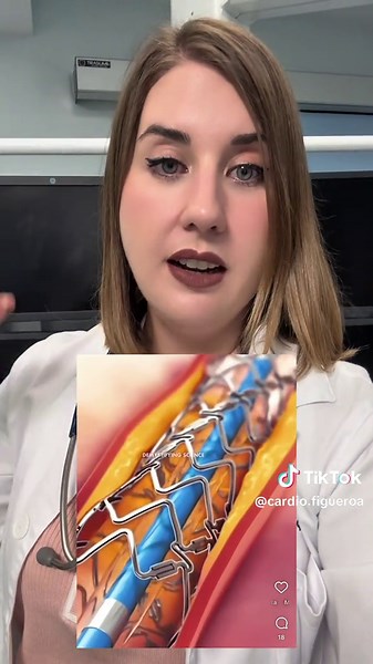 🫀 Qué es un cateterismo cardiaco? 🫀 En este video te cuento cómo es el procedimiento que usamos para “ver” desde dentro las arterias de tu corazón, diagnosticar más posibles obstrucciones e incluso tratarlas mediante la colocación de un stent ✨ Te imaginabas que fuera así? Te leo 👀 #cateterismo #infarto #salud #bienestar #colesterol
