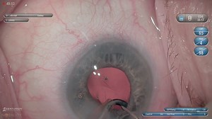Leveraging Laser Cataract Surgery in Eyes With Small Pupils - Eyetube