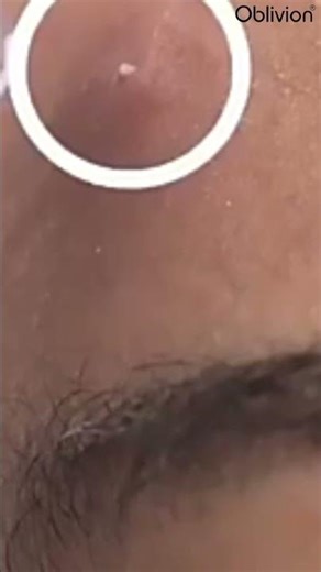 Blackhead & Whitehead Extractor Device – Vacuum Pore Clean_blackhead_extractor_tool #oblivion