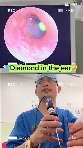 Pressure Point to Unclog Ears FAST! 👉 (Dr. ENT's Trick) #EarWax #ENT #Hack #earcare #earwaxremoval