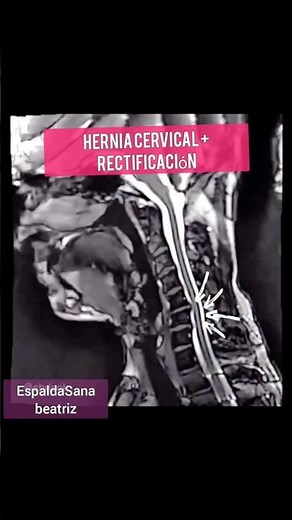 ✅Rectificación Cervical y Hernia 🧠 Qué Es y cómo Mejorar +40