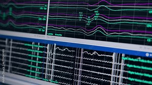 Brain work curves on the computer monitor. Close up. Neuromonitoring in treating neurologic issues.