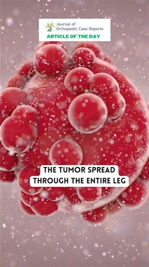 The tumor spread through the entire leg