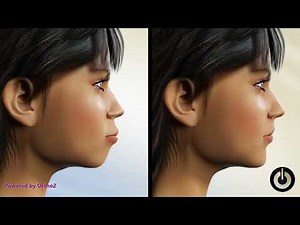 Bimaxillary Protrusion | 4 Premolar Extraction for Lip Profile Improvement