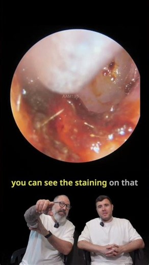 Wax Stuck to the Eardrum Like Chewing Gum — and That's Not All 👂 - MEP195