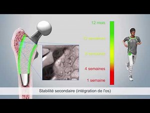 Mathys: optimys – de la stabilité primaire à la stabilité secondaire, phases de rééducation incluses