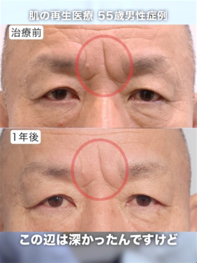 ▼肌の再生医療ってどんな治療？ お肌の老化の原因は「肌細胞の減少」です。 「肌細胞」が減って、老化したお肌に再び「肌細胞」を増やしてあげることで シワやたるみ等の老化症状が現れる前の若々しいお肌の状態に戻します ▼こちらの動画では「肌の再生医療」の実際の治療の様子を紹介しています https://youtu.be/4oEN9PdDdII -------------------------------------------------- もし「肌の再生医療」に興味を持っていただけたら こちらもご案内しております ▼「肌の再生医療」のカウンセリングを受けてみたい方はこちらから https://cellbank.co.jp/counseling/?route=tiktok ▼「肌の再生医療」が受けられる医療機関はこちら https://cellbank.co.jp/search/?tk260426 -------------------------------------------------- □北條元治のInstagram https://www.instagram.com/hojo