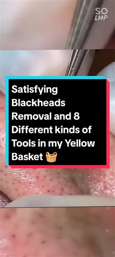 Satisfying Videos with 8 kinds of Tools.. You can Buy the Tools For Only P99.98 its 8 Different kinds of Tools #acne #acnetools #acnetoolkit #acnetoolsfaceskincare #acnetoolkitset #blackhead #blackheads #blackheadsremoval #ingrownhair #ingrownhairremoval #satisfyingvideo #satisfyingvideos #fyp