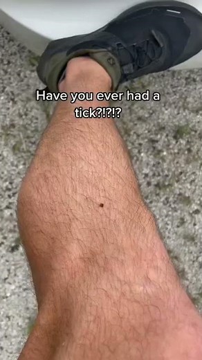 Doctor Teaches: HOW TO REMOVE A TICK