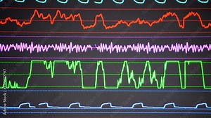 Modern patient monitor. Electronic Health Monitor displaying medical indicators and graphs of patient vital activity. Medical vital signs. Screen of computer monitor in hospital. Cardiogram ECG Pulse