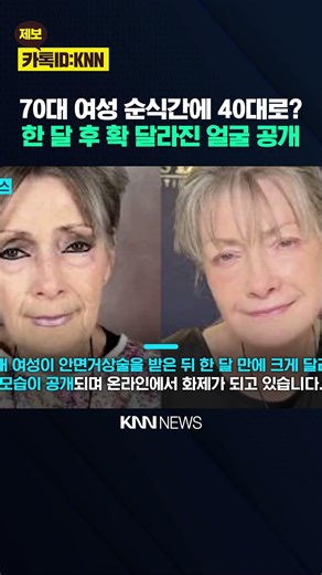 "이 성형 받고 회춘했어" 30년 젊어진 기적의 수술? / KNN