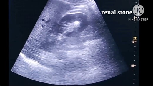 Twinkling artifact on ultrasound | Radiology Interesting Cases