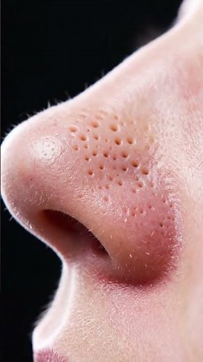 “Most Satisfying Blackhead Vacuum Extraction Ever! Real Deep Pore Cleaning ASMR for Stress Relief,