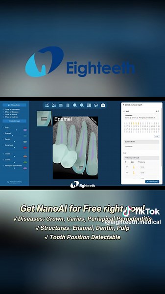 Check out how to detect Diseases, Structures, and Tooth Position by Nano AI! √ Diseases: Crown, Caries, Periapical Periodontitis √ Structures: Enamel, Dentin, Pulp √ Tooth Position Detectable Nano Al - The First Al Diagnostic System Built into a Sensor —Your Patient Education & Conversion Tool— #Eighteeth #newproductlaunch #dentalcare #Nanopix #AI #digitalsensor #dentistryworld #Aldiagnosis #xrayimaging