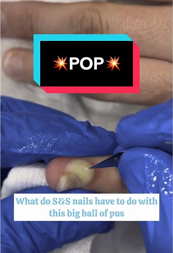 Abscess Drainage Procedure Explained by Jess the Osteo